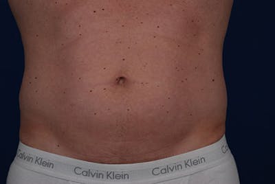 Coolsculpting Before & After Gallery - Patient 12973820 - Image 2