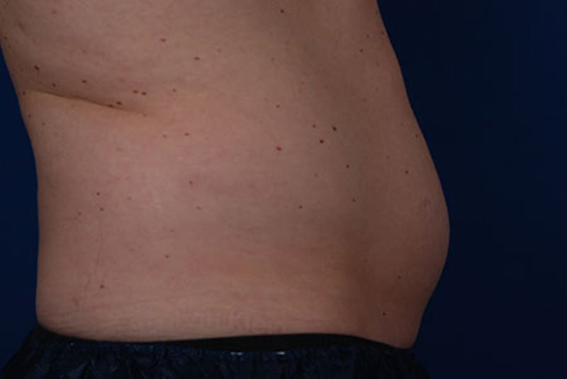 Coolsculpting Gallery - Patient 12973820 - Image 3