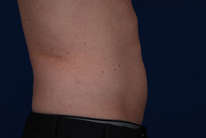 Coolsculpting Before & After Gallery - Patient 12973820 - Image 4