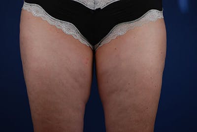 Coolsculpting Before & After Gallery - Patient 12973824 - Image 1