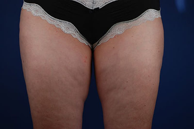 Coolsculpting Before & After Gallery - Patient 12973824 - Image 1