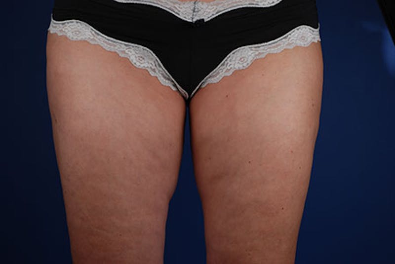 Coolsculpting Before & After Gallery - Patient 12973824 - Image 2