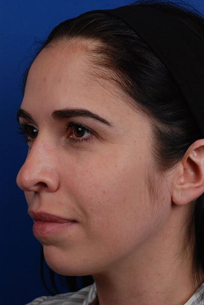 Chin Before & After Gallery - Patient 12973826 - Image 1