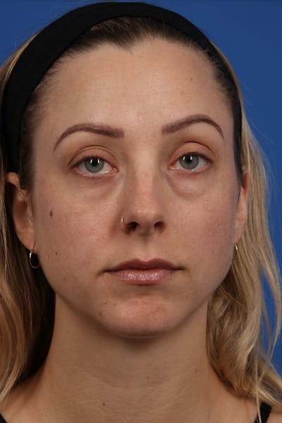 Cheeks Before & After Gallery - Patient 12973829 - Image 1
