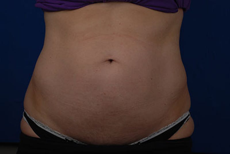 Coolsculpting Gallery - Patient 12973831 - Image 1