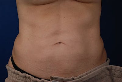 Coolsculpting Before & After Gallery - Patient 12973831 - Image 2