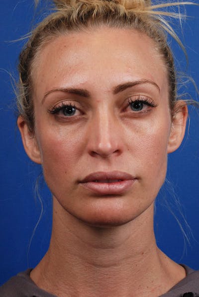 Full Face Before & After Gallery - Patient 12973833 - Image 1