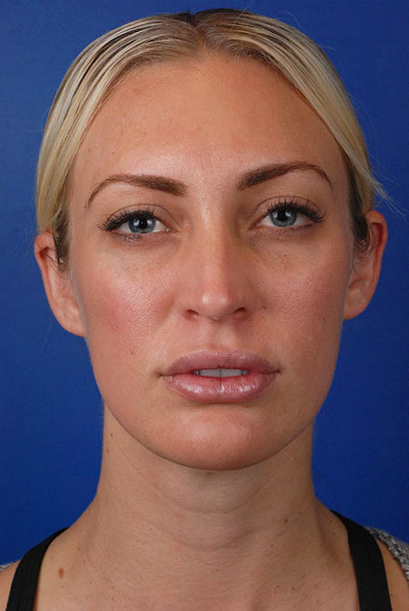 Full Face Before & After Gallery - Patient 12973833 - Image 2