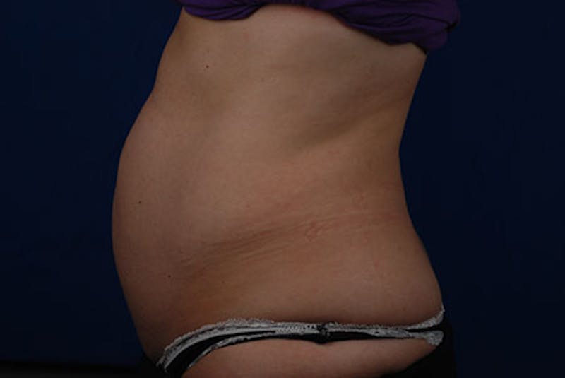 Coolsculpting Before & After Gallery - Patient 12973831 - Image 3