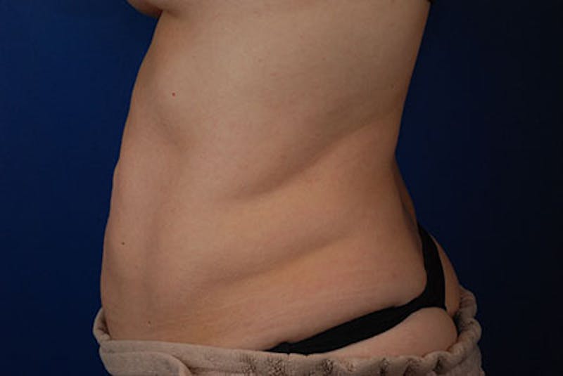 Coolsculpting Before & After Gallery - Patient 12973831 - Image 4
