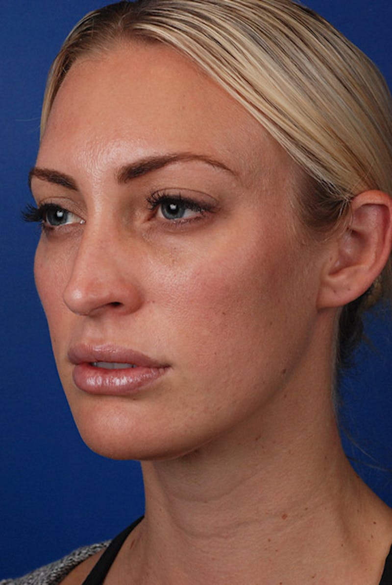 Full Face Before & After Gallery - Patient 12973833 - Image 4