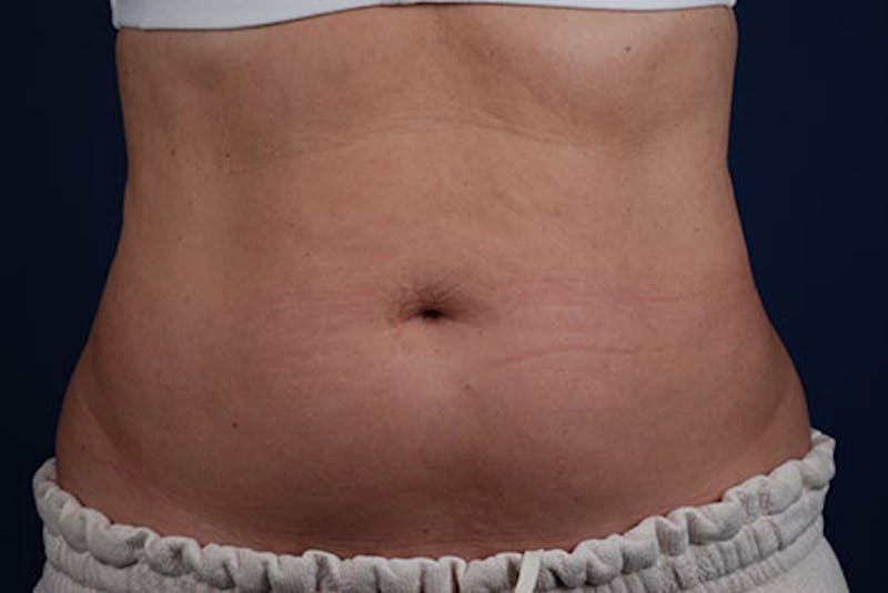 Coolsculpting Before & After Gallery - Patient 12973834 - Image 1