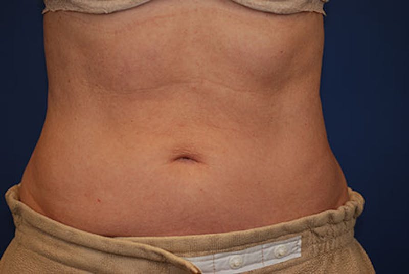 Coolsculpting Gallery - Patient 12973834 - Image 2