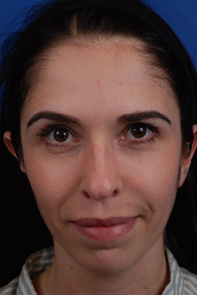 Full Face Before & After Gallery - Patient 12973835 - Image 1