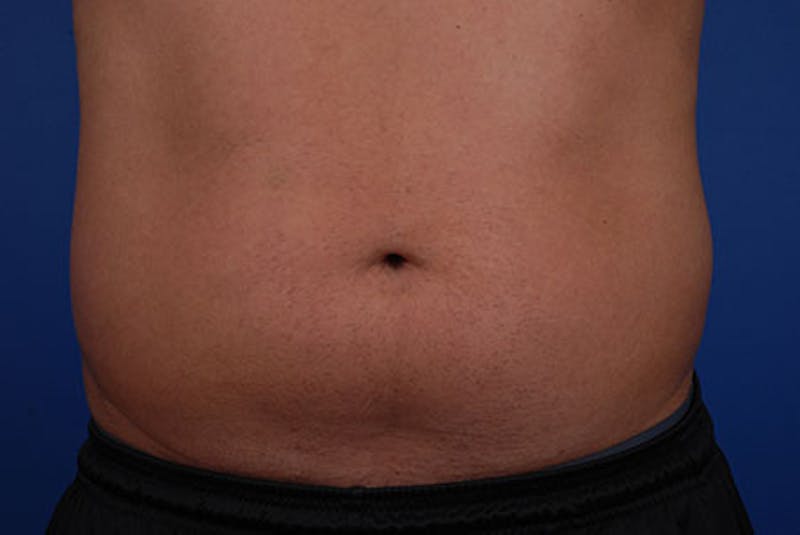 Coolsculpting Before & After Gallery - Patient 12973836 - Image 1