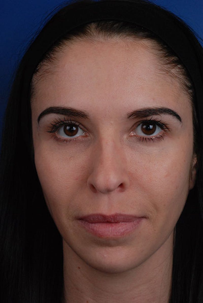 Full Face Before & After Gallery - Patient 12973835 - Image 2