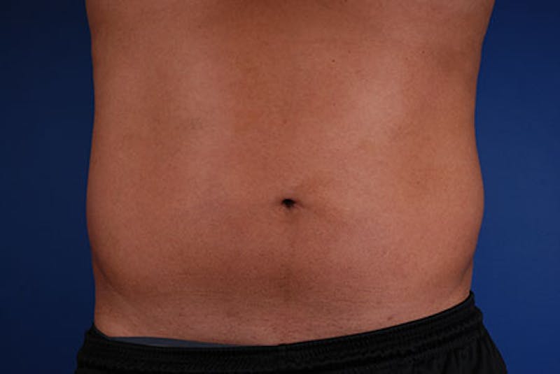 Coolsculpting Before & After Gallery - Patient 12973836 - Image 2