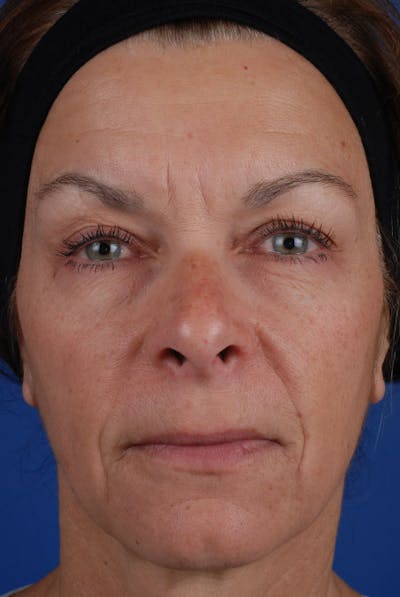 Full Face Before & After Gallery - Patient 12973840 - Image 1