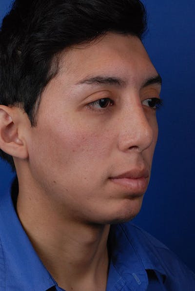 Jawline Before & After Gallery - Patient 12973838 - Image 1