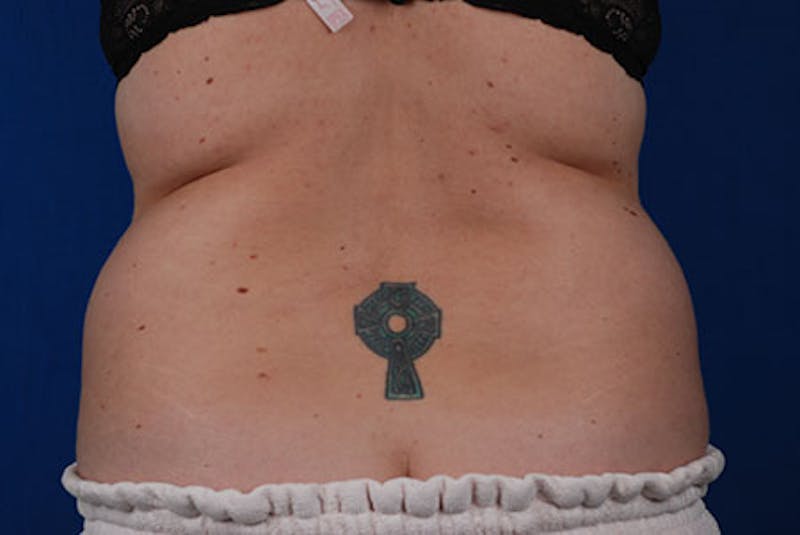Coolsculpting Before & After Gallery - Patient 12973839 - Image 1