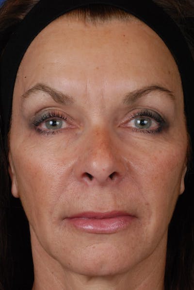 Full Face Before & After Gallery - Patient 12973840 - Image 2