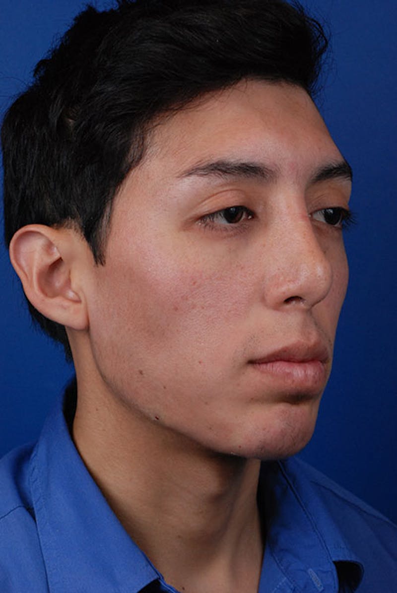 Jawline Before & After Gallery - Patient 12973838 - Image 2