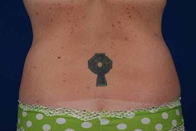 Coolsculpting Before & After Gallery - Patient 12973839 - Image 2