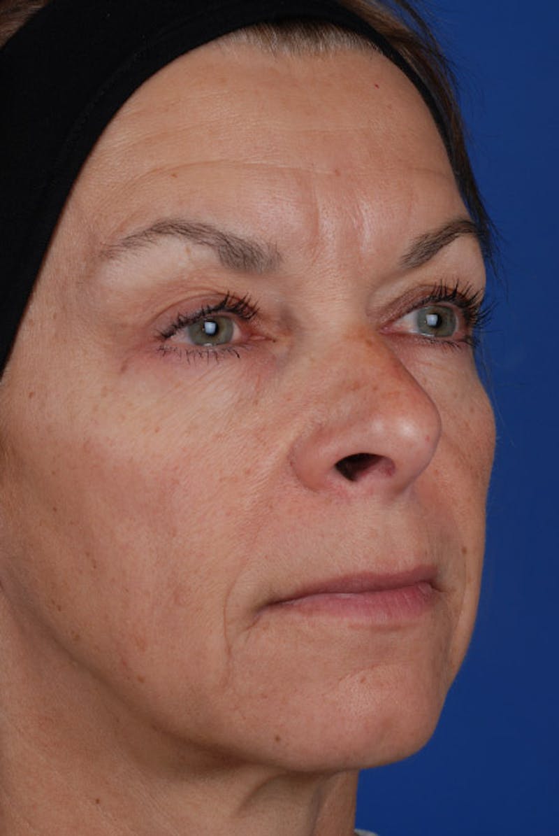 Full Face Before & After Gallery - Patient 12973840 - Image 3
