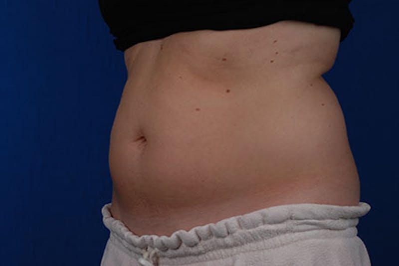 Coolsculpting Before & After Gallery - Patient 12973839 - Image 3