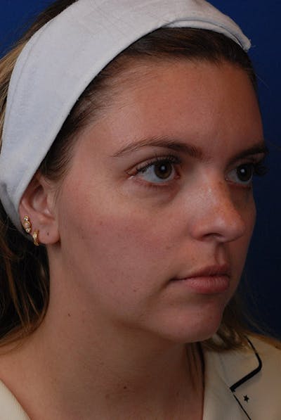 Jawline Before & After Gallery - Patient 12973844 - Image 1