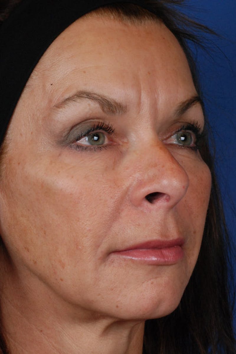 Full Face Before & After Gallery - Patient 12973840 - Image 4