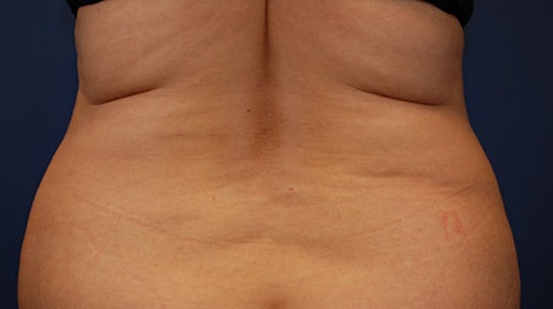 Coolsculpting Gallery - Patient 12973841 - Image 1