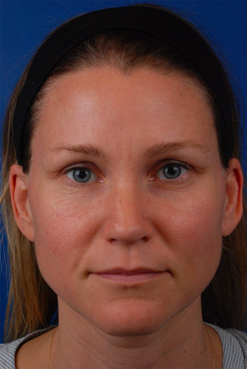 Full Face Before & After Gallery - Patient 12973842 - Image 1