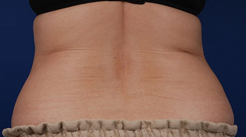 Coolsculpting Before & After Gallery - Patient 12973841 - Image 2