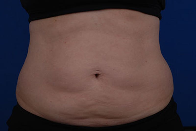 Coolsculpting Gallery - Patient 12973846 - Image 1