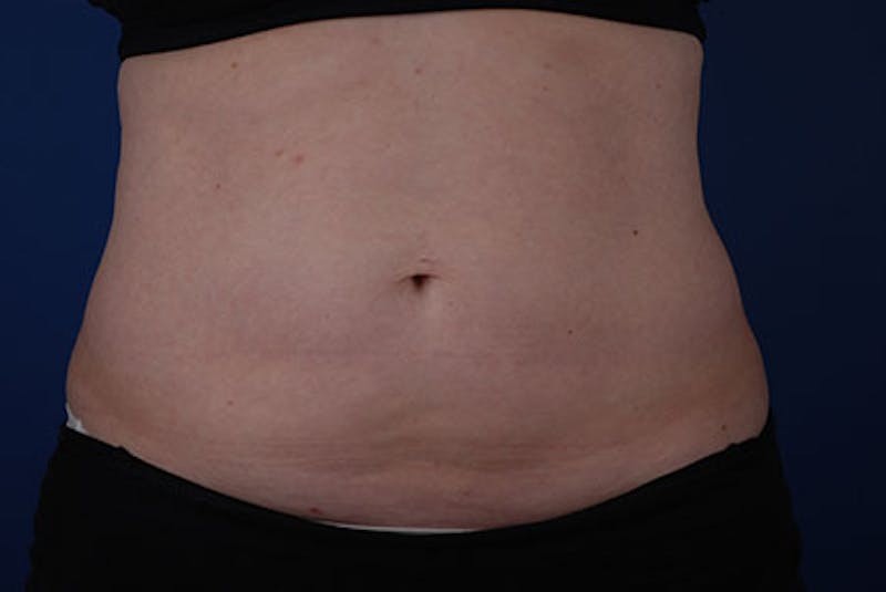 Coolsculpting Gallery - Patient 12973846 - Image 2