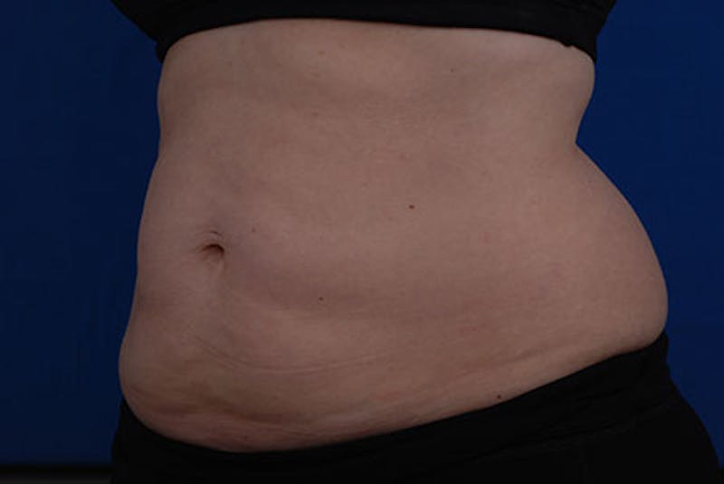 Coolsculpting Before & After Gallery - Patient 12973846 - Image 3