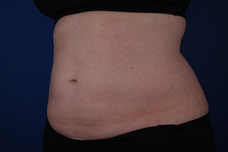 Coolsculpting Before & After Gallery - Patient 12973846 - Image 4