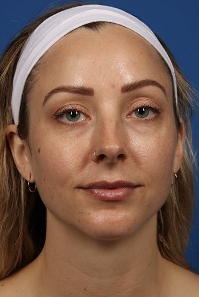 Full Face Before & After Gallery - Patient 12973851 - Image 2