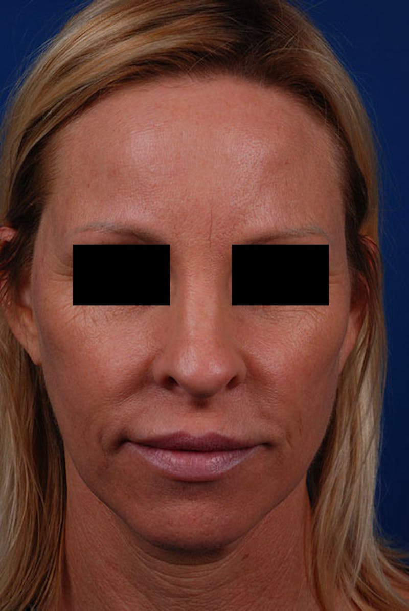 Sculptra Before & After Gallery - Patient 12973853 - Image 1