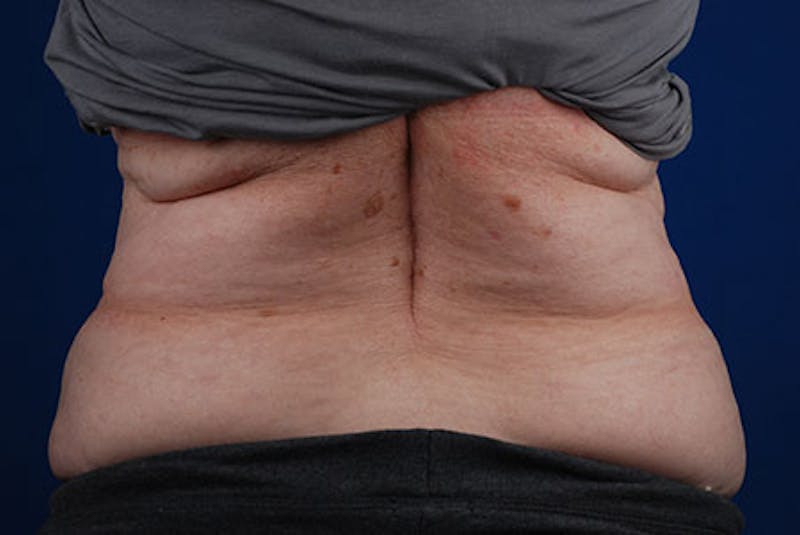 Coolsculpting Before & After Gallery - Patient 12973849 - Image 1