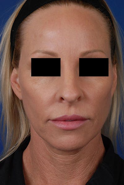 Sculptra Before & After Gallery - Patient 12973853 - Image 2