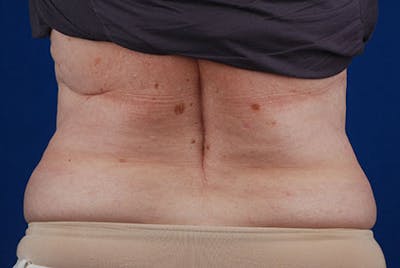 Coolsculpting Before & After Gallery - Patient 12973849 - Image 2