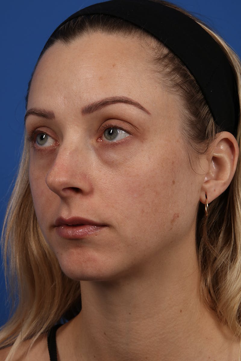 Full Face Before & After Gallery - Patient 12973851 - Image 3