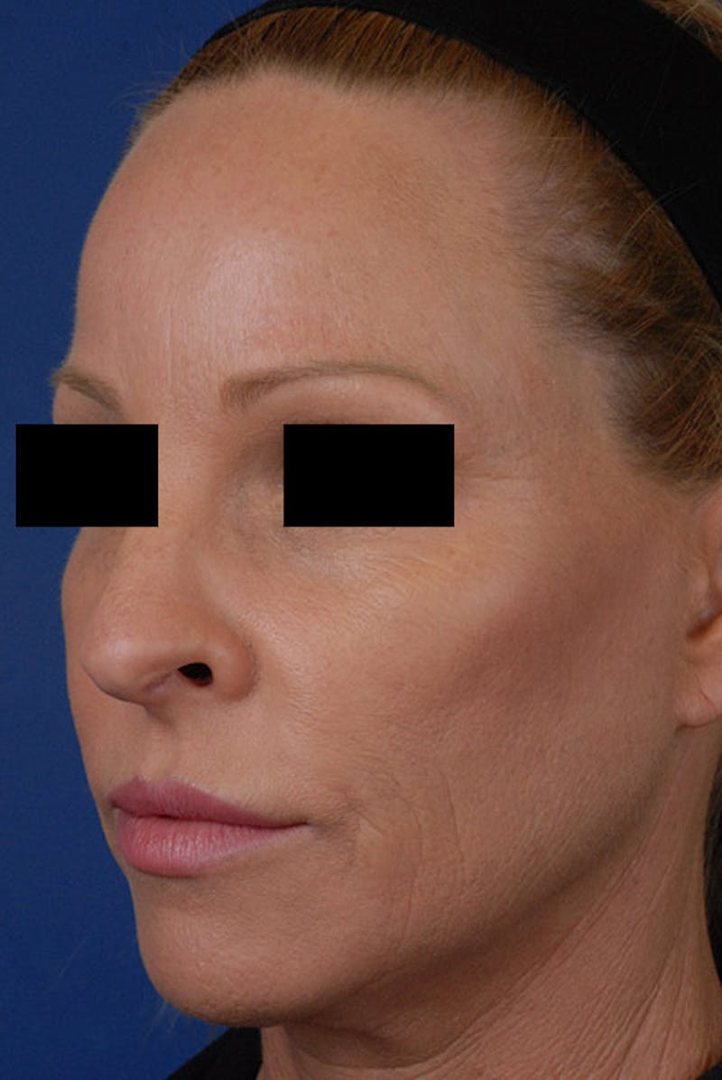 Sculptra Before & After Gallery - Patient 12973853 - Image 4