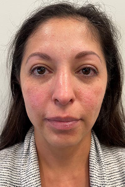 Full Face Before & After Gallery - Patient 12973865 - Image 1