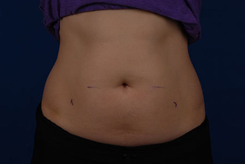 Coolsculpting Before & After Gallery - Patient 12973855 - Image 1