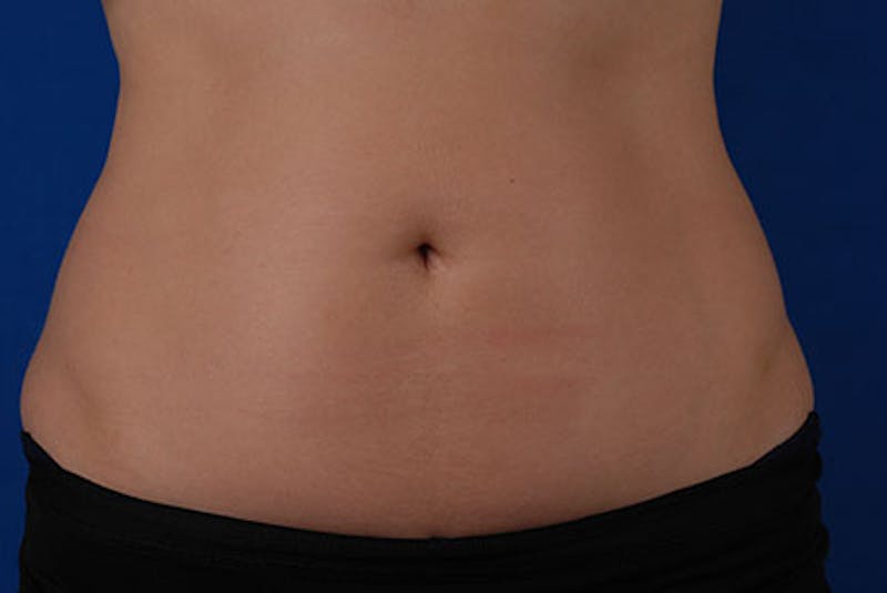 Coolsculpting Before & After Gallery - Patient 12973855 - Image 2