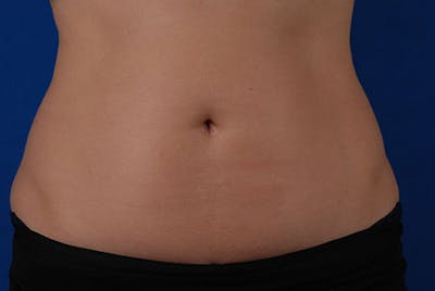 Coolsculpting Before & After Gallery - Patient 12973855 - Image 2
