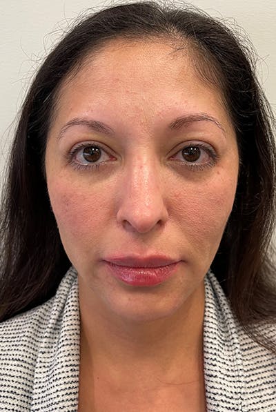 Full Face Before & After Gallery - Patient 12973865 - Image 2